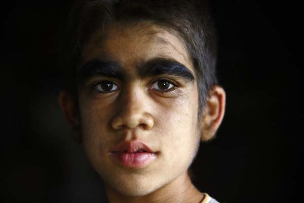 So, she decided to travel to Kathmandu with them to get treatment.