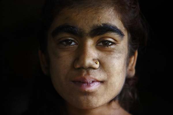 But her children faced bullying every day because of their appearance.